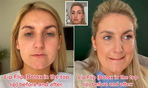 Everything You Need to Know About the Botox Lip Flip